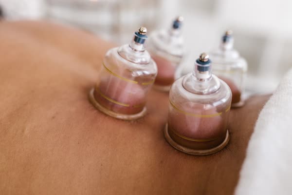 Cupping therapy tools placed on the skin to improve circulation